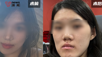 武大口腔医院回应女孩做正颌手术反成鞋拔子脸