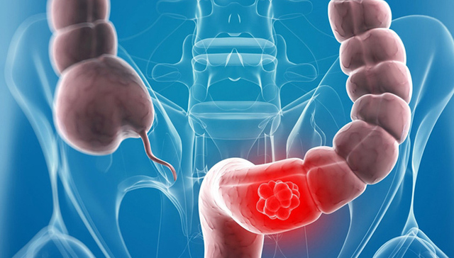 大肠癌可能成为新癌王 三高一低和久坐不动是首要致病因素