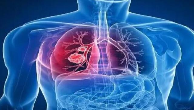 天津一中心医院改进肺部小结节术前定位及手术方式