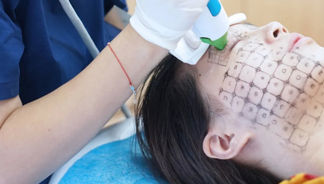 消费,医美,热玛吉