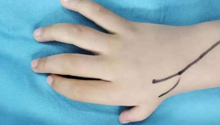 神奇！食指再造“变”拇指！多亏了这群普陀人的“金手指” 