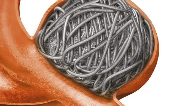 医疗,集中采购,联盟集采,神经介入耗材