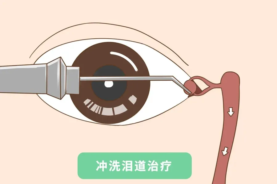 总是“泪眼汪汪”?合肥普瑞眼科专家:警惕泪道“下水道”堵塞!|界面新闻